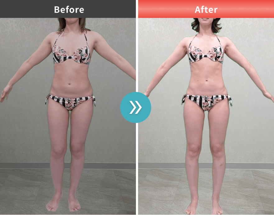 堀口ミイナ様 施術前